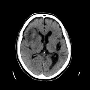 En un corte inmediatamente inferior, se aprecia un área de densidad de 3 x 1 cm en región frontoparietal izquierda que podría corresponder a un sangrado. Se observa un área de edema hipodensa a su alrededor.