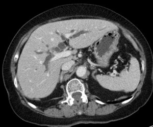 Se observa en el hígado una hipodensidad "en ramas", lo cual es la vía biliar intrahepática dilatada.