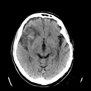 Otro corte más inferior.