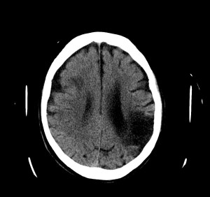 En el lóbulo parietal derecho se observa un área hipodensa de porencefalia por lesión isquémica crónica (AP ictus hace 2 años).
