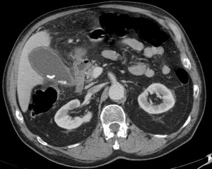 En un paciente con Murphy positivo se observa: Vesícula distendida, con litiasis en su interior, paredes engrosadas, líquido e infiltración de la grasa perivesicular. Hallazgos compatibles con Colecistitis