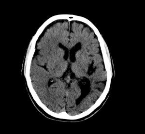 En el mismo corte, hace diez días no se observa la imagen de sangrado. Sin embargo, siempre hay que pasar a ventana de isquemia antes de dar por concluido el estudio
