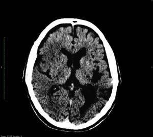 Ya se intuía en la imagen anterior, un área algo más hipodensa que su homónima contralateral. Forzando la ventan, podemos visualizar en región frontoparietal derecha, un área hipodensa que correspondería a lesión isquémica.