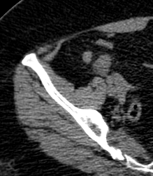 Se observa el apéndice que ha perdido la morfología tubular y en su porción distal forma una masa mal definida con infiltración de la grasa pericecal, la cual trata de contener la inflamación y mircoperforación que se puede haber producido.