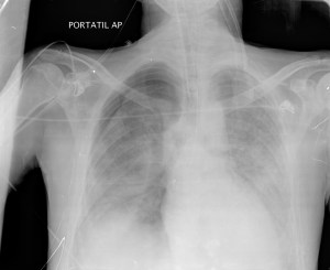 Debida a la ventilación y rotura de quistes, el paciente desarrolla un neumotórax como complicación añadida.