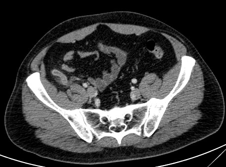 Se observa el apendice aumento de calibre y con las paredes engrosadas y realzadas tras la administración de contraste intravenosos