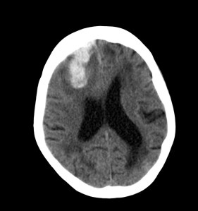 Esta imagen es un sangrado masivo en fase aguda. Puede corresponder a un infarto con transformación hemorrágica o cualquier otra entidad que produzca un hematoma intracraneal. El aumento de densidad es notable, difiere de una perfusión del lujo, donde la densidad es más similar a la de los senos venosos del cerebro.