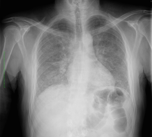 Opacidad difusa bilateral de ambos hemitorax. En bases pueden intuirse. opacidades mutifocales. Estos hallazgos son inespecíficos, pero en el contexto de un paciente inmunodepremido, la primera posibilidad diagnóstica es un PCP.