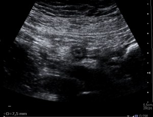 Sección axial. Diámetro máxmimo >6 mm, significativo para apendicitis.