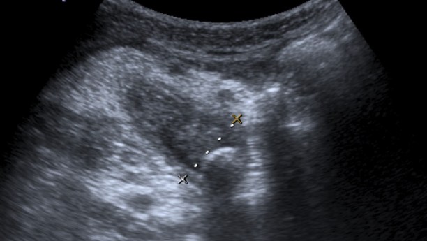 Apendicolito en extremo distal del apéndice. Engrosamiento mural, aumento de calibre y contenido en el interior del mismo.