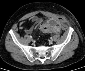 Paciente con antecedente de drenaje de absceso por diverticulitis complicada. Nuevamente con dolor en FII, se aprecia un segmento de colon inflamado con colecciones pericólicas y extensión a partes blandas.