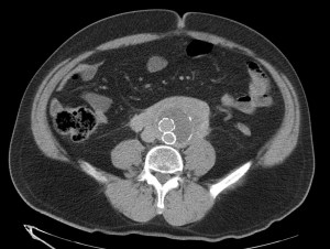 Masa que rodea la aorta en porción anterior.