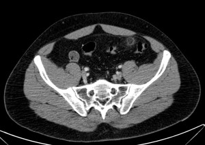 En FII, se observa aumento de la atenuación del Epiplon con realce periférico.