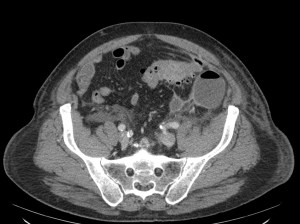 Segmento de sigma con engrosamiento mural y oclusión de la luz y abesceso pericólico adyacente más inftiltración de la grasa del mesenterio.