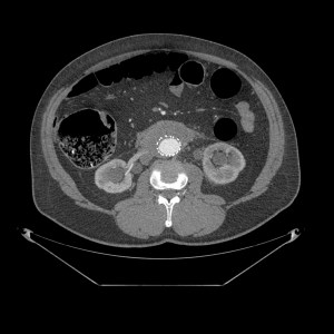 Corte a nivel renal. Protesis aórtica sin alteaciones.