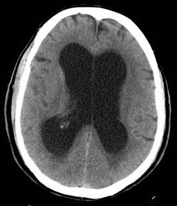 Mala evolución con desarrollo de hidrocefalia obstructiva.