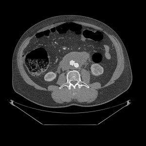 Corte a nivel bifurcación iliaca. Prótesis aórtica sin alteraciones.