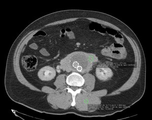 La masa es isodensa con respecto al músculo. 67 UH aprox.