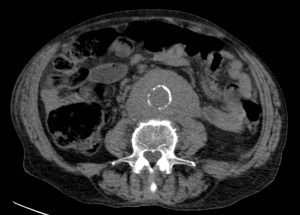 Se aprecia el signo de la aorta flotante: Aorta separada de la columna lumbar, inmersa en una masa de partes blandas que presenta discreto aumento de atenuación