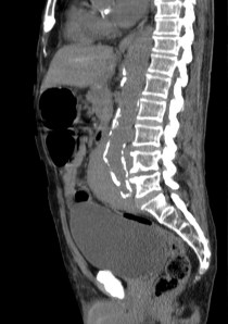 Observar como la Aorta calcificada atraviesa la masa abdominal.
