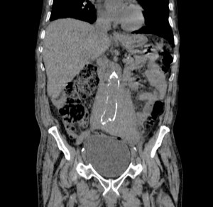 Reconstrucción Coronal. Mismo concepto, la Aorta atraviesa la masa.
