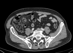 Se aprecia una zona adyacente al ciego con atenuación aumentada y cierto realce periférico que por la localizción en la epiplon (grasa + vasos) podemos catalogar de Apendagitis.