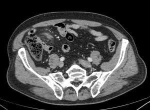 Corte más inferior.