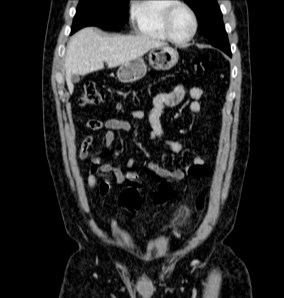 Reconstrucción coronal.