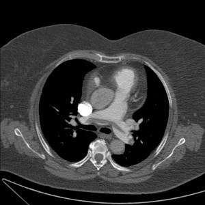 TEP agudo en silla de montar, el trombo se extiende desde una arteria pulmonar a la otra.
