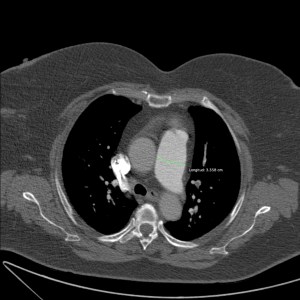 Cono de la pulmonar de calibre aumentado.