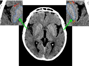 Se presentan las dos zonas insulares, que es la región del cerebro que podemos identificar adyacente a la cisura de Silvio. La flecha ROJA indica el ribete de sustancia gris (que se blanco con TC) el cual está ausente en el lado derecho "Signo del Ribete Insular", La muesca AZUL muestra la afectación del Lenticular derecho y las líneas NARANJAS muestra la Cápsula externa, que es sustancia blanca (que se ve gris en TC) y la cual no se diferencia bien de la ínsula en región derecha.