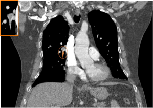 Signo de Rail de tren en un corte perpendicular a la arteria segmentaria del LM, sugestivo de TEP agudo.