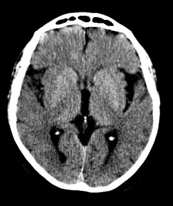 Ribete insular derecho + hipoatenuación del núcleo Lenticular derecho
