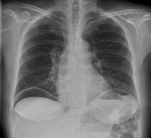 Presencia de gás subdiafragmático, más evidente en hemidiafragma derecho. Consitutye un signo compatible con Neumoperitoneo.