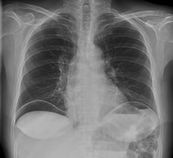 Presencia de gás subdiafragmático, más evidente en hemidiafragma derecho. Consitutye un signo compatible con Neumoperitoneo.