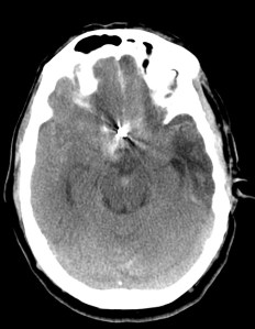 Aneurisma de la ACA intervenido con material de cirugía.