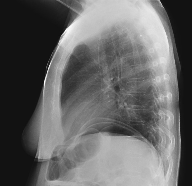 Gas subdiafragmático, visión en placa lateral.