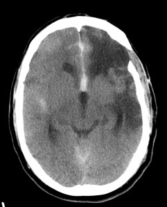 HSA de la ACA, sangrado en la cisura interhemisferica anterior, que tras la intervención quirúrgica ha sufrido una isquemia cerebral del territorio fronto parietal izquierdo.