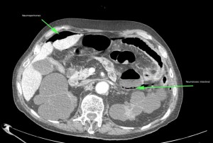 Neumoperitoneo y asas intestinales con signos de neumatosis intestinal, compatible con isquemia intestinal perforada.