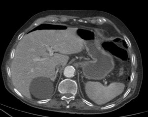 Se observa gas intraperitoneal, anterior al hígado