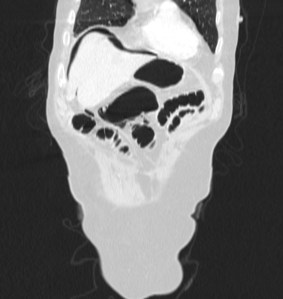 Reconstrucción coronal. Aire subdiafragmático y posterior.