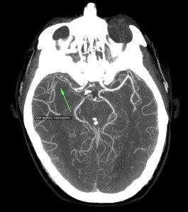Vasoespasmo de la ACM derecha y las ramas de su territorio, compárase con la contralateral.
