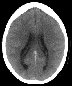 Persistencia de una "cuerda hiperdensa"  posterior, localizada a nivel de la cisura interhemisférica.