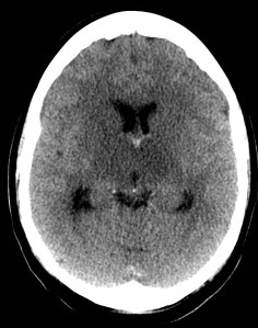 Hipodensidad de ambos tálamos, bilateral y simétrica, que afecta también a la cabeza del caudado derecho.  