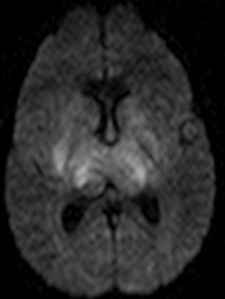 Restricción en la secuencia difusión. Estos hallazog sy los vistos en el FLAIR son compatibles con isquemia secundaria a trombosis venosa profunda bilateral.
