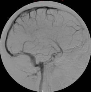 Permeabilidad de seno longitudinal superior y transverso derecho. No se objetiva inicio de seno transverso izquierdo. No visualización de venas cerebrales internas ni vena de galeno. 