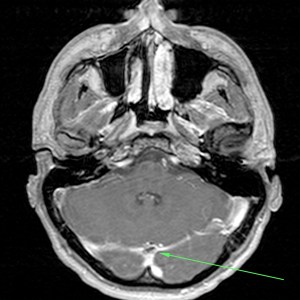 Defecto de repleción.