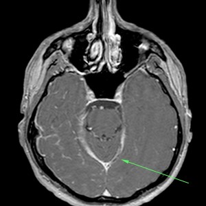 Defecto de repleción en tentorio drecho.