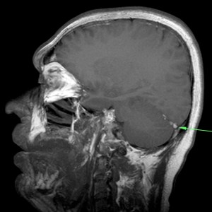 Senñal hiperintensa en T1 que correspone al seno trombosado.