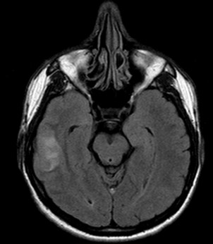 Lesión Hiperintensa en FLAIR